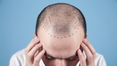 How to Calculate the Number of Grafts Required for a Hair Transplant