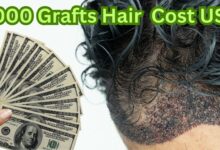 5000 Grafts Hair Transplant Cost in the USA